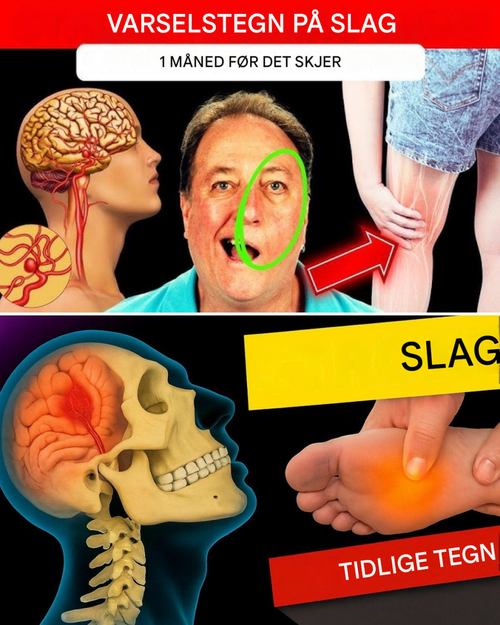8 varseltegn på hjerneslag én måned før + 9 effektive tips for å forebygge det