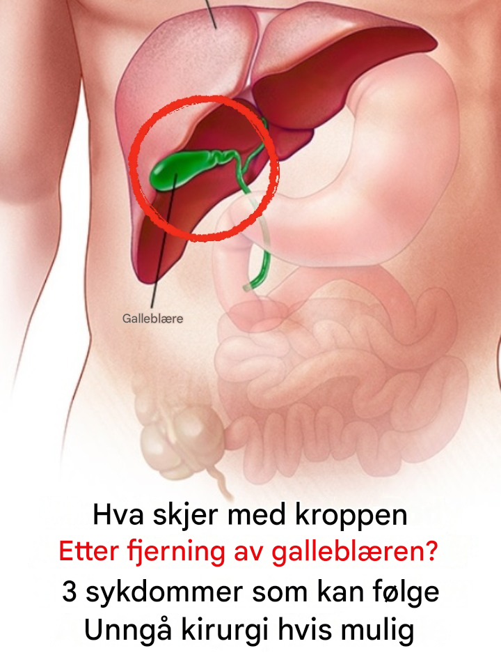 Hva skjer med kroppen etter fjerning av galleblæren? 3 sykdommer som kan følge – Unngå kirurgi hvis mulig