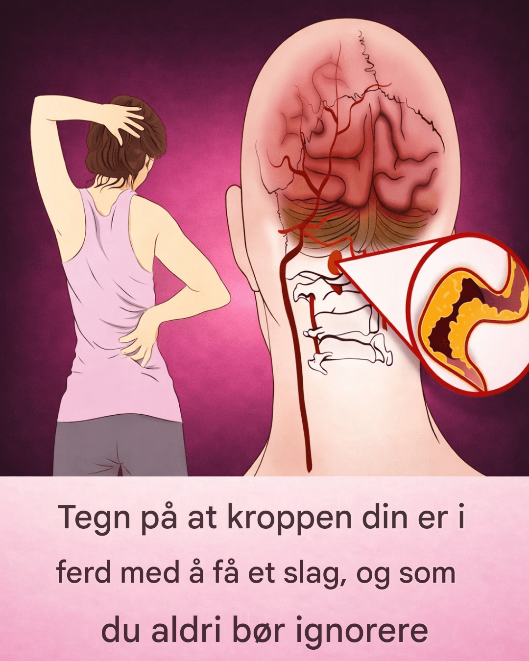 10 tidlige varseltegn på hjerneslag som alle bør kjenne til for å iverksette tiltak raskt